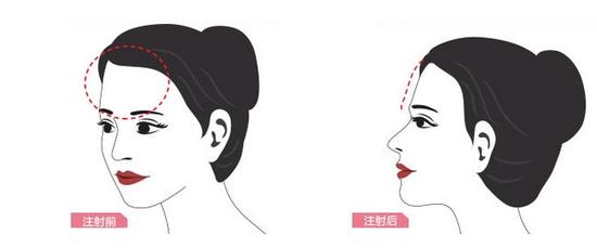 自体脂肪填充额头,塑造饱满好命额头|额头|面部