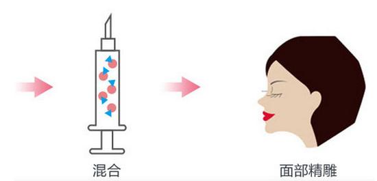 自体脂肪填充额头,塑造饱满好命额头|额头|面部