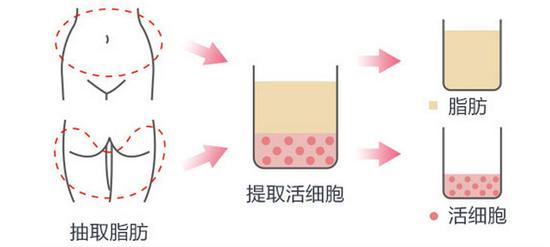 自体脂肪填充额头,塑造饱满好命额头|额头|面部