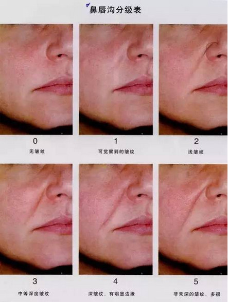 自体脂肪填充鼻唇沟,赶走法令纹年轻十岁|鼻唇