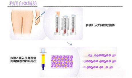 自体脂肪填充鼻唇沟,赶走法令纹年轻十岁|鼻唇