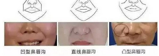 鼻唇沟的类型