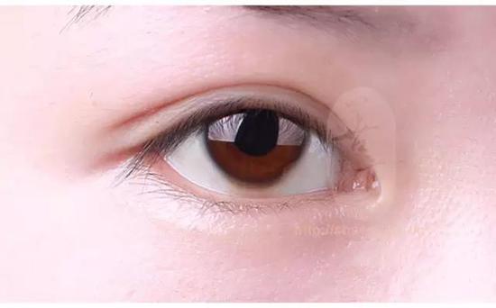 不要只顾好看!双眼皮术前这些问题你需要了解