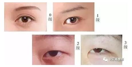 双眼皮+开眼角手术