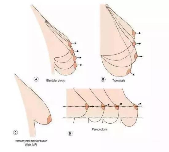 乳房的下垂是有阶段性的