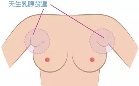 副乳切除