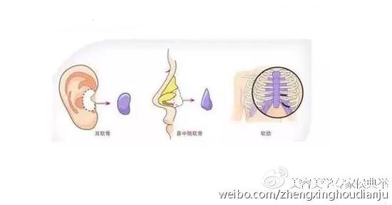 自体软骨隆鼻