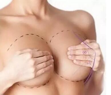 乳房整形项目大全|乳房|丰胸|隆胸