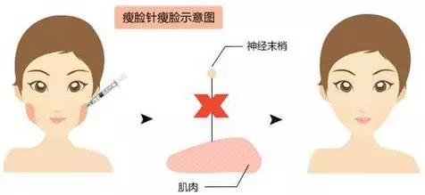 瘦脸效果维持时间