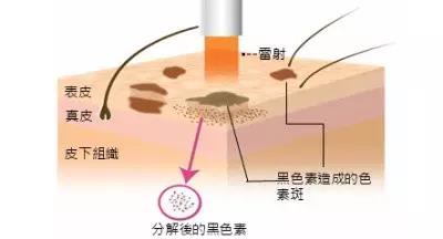 知道你为什么会长色斑吗?看完崩溃了|皮肤|黑色素|色斑_新浪女性_新浪网