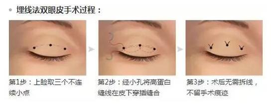 埋线双眼皮这样做，效果更持久!