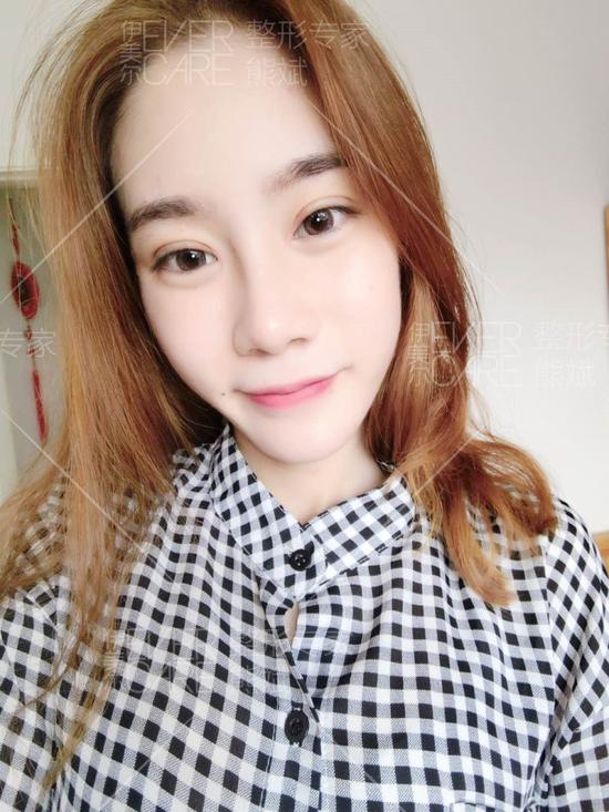 解析眼鼻综合打造的整体效果|自体脂肪填充|双