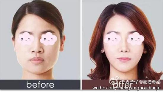 瘦脸针的人原理是什么_瘦脸针打了人变老了图