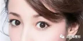 双眼皮