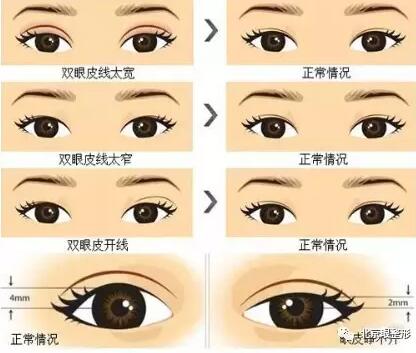 双眼皮
