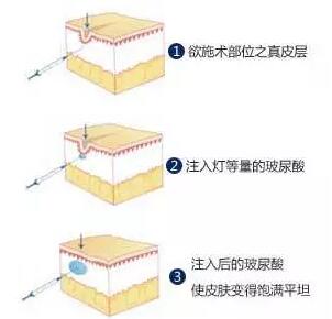 玻尿酸填充鼻唇沟原理