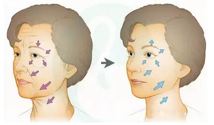面颊组织下垂