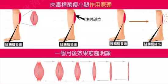 注射除皱,玻尿酸和肉毒素这么打,效果更好!|玻尿