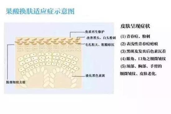 果酸换肤