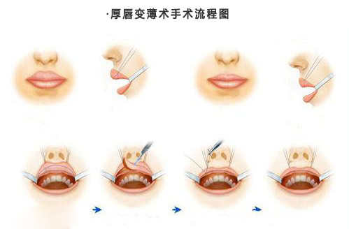 厚唇变薄术