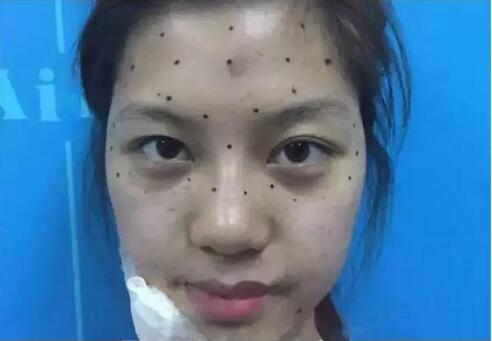 移动度很小,本来下垂就很小,提升基本没效果,只需用低剂量的肉毒素