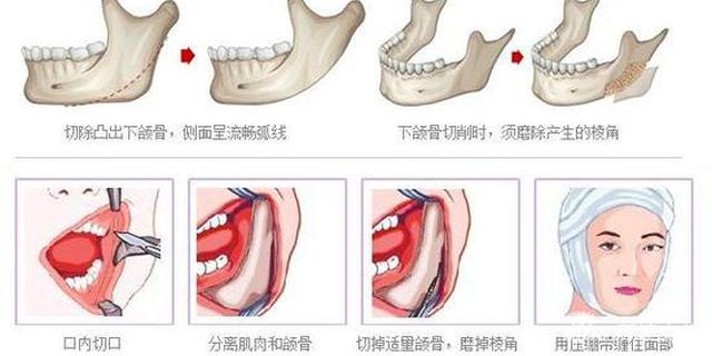 下颌角截骨术