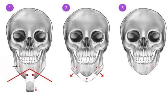 下巴缩短手术