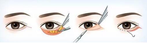 眼袋手术