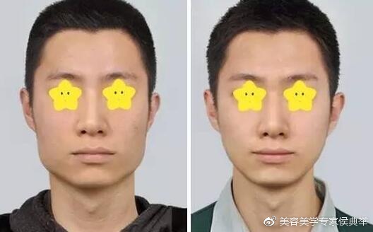 这都不知道?难怪你打了一筐瘦脸针都没用!|瘦