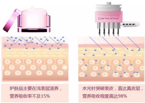 和注射用玻尿酸有什么区别？