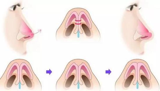鼻综合整形术后觉得还是太低怎么办?|隆鼻|鼻综