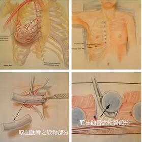 自体肋软骨隆鼻