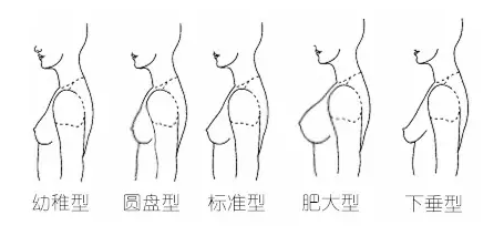 再细分一些包括,圆盘型,幼稚型,肥大型,悬垂型 幼稚型 乳腺基本未发育