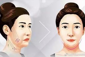 面部提升术硬米籽原因 线雕热玛吉拉皮区别