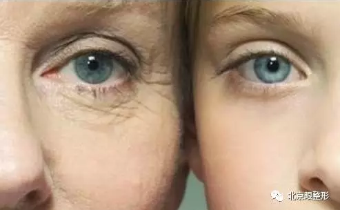 眼周纹