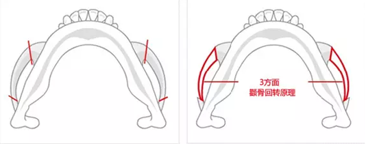 3D颧骨回旋术