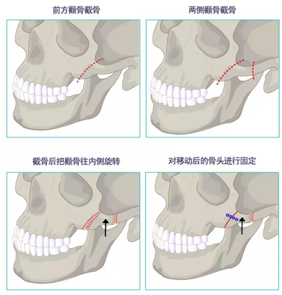 3D颧骨回旋术