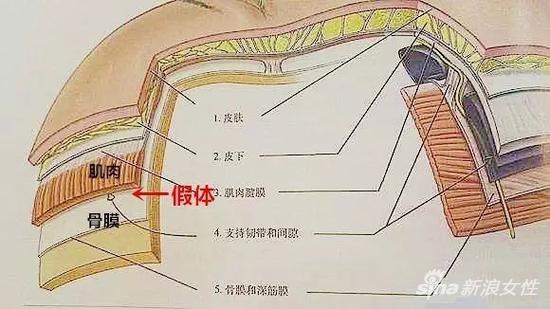 假体植入的位置