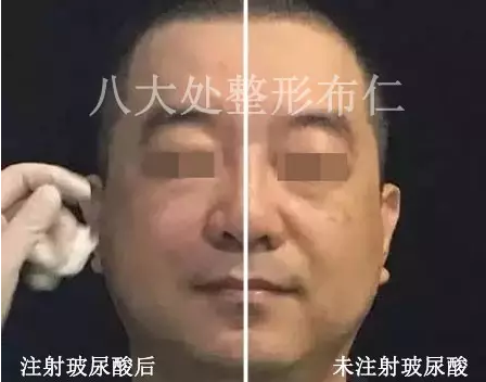 鱼尾纹