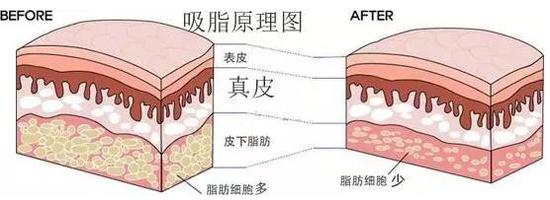 吸脂