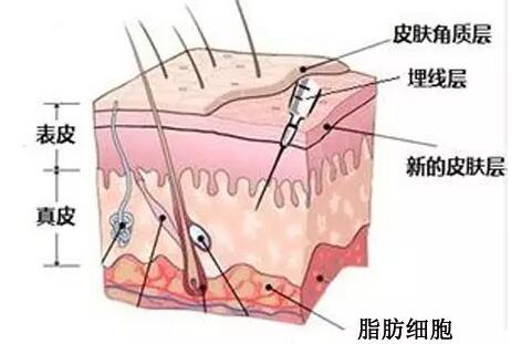 面部埋线