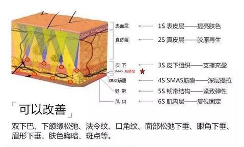 线雕