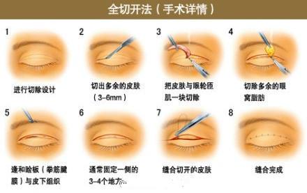 双眼皮拆线会很疼吗?|双眼皮|双眼皮手术|伤口_新浪女性_新浪网