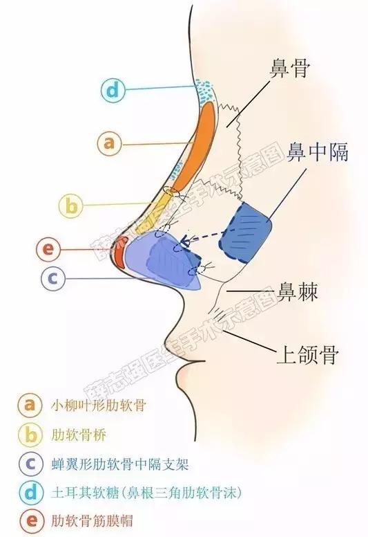 因"料"制宜,将取出的肋软骨进行片式雕刻,按照鼻部解剖学特点五段式
