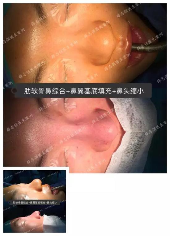 2）弓状鼻孔等复杂的鼻尖问题需要一并处理时，肋软骨可以提供更稳定有效的解决方案