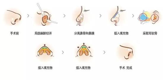 一篇文章读懂肋软骨鼻综合|肋软骨|软骨|鼻中隔