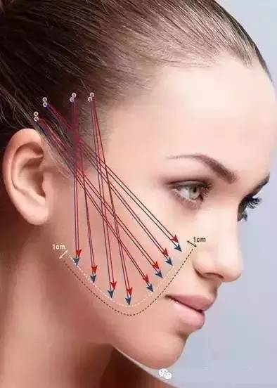 为什么面部埋线和注射整形,最好一起做?|衰老|