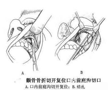 颧骨前内骨折手术