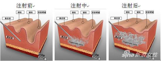 玻尿酸注射