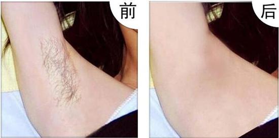腋臭